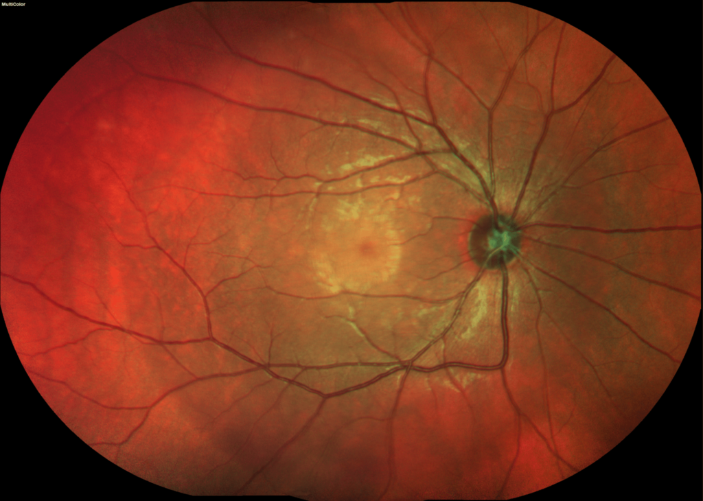 spectralis-culticolor-55-montage_no-abnormalities-found